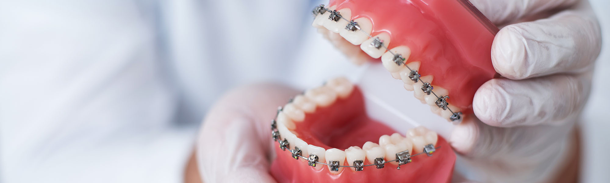 Metal Braces Carson CA