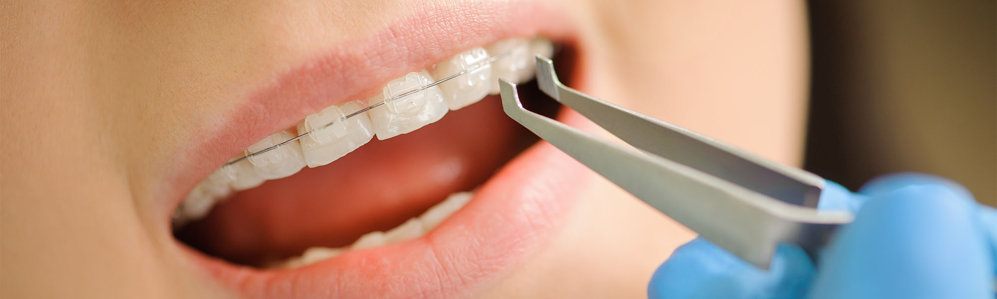 What Are Ceramic Braces