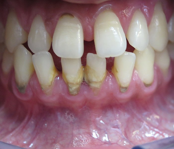 Teeth Cleaning Before