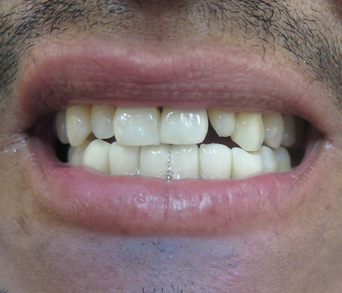 Veneers Before