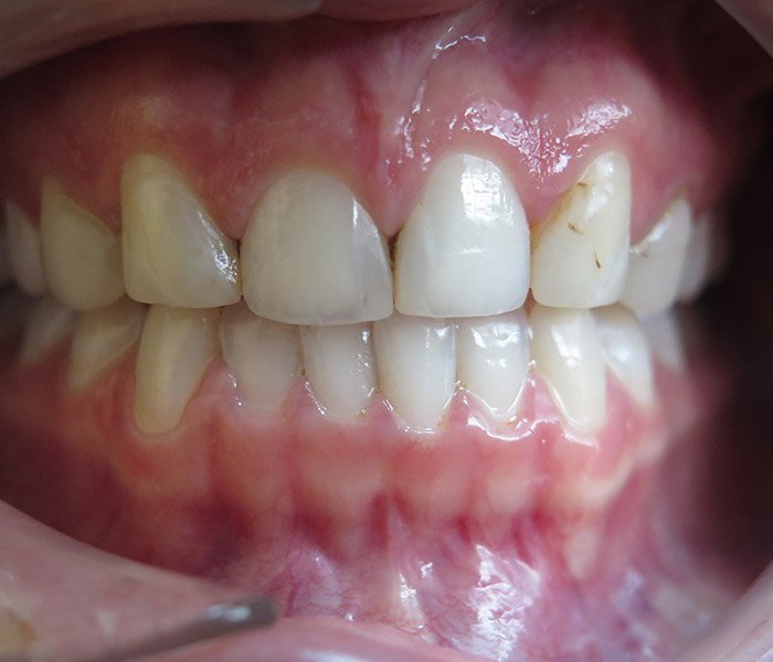 Veneers Before