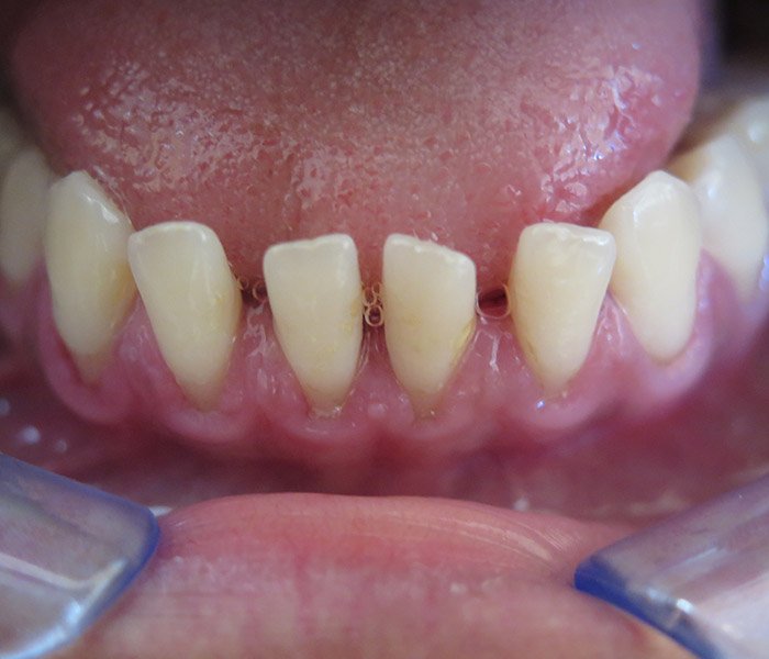 Teeth Cleaning After