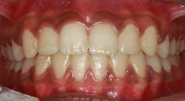 Orthodontics After