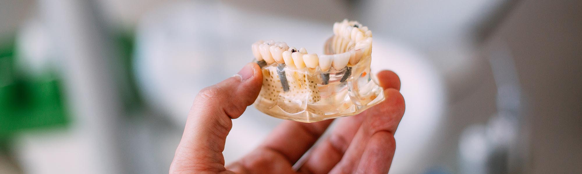 All on 4 Dental Implants Carson CA