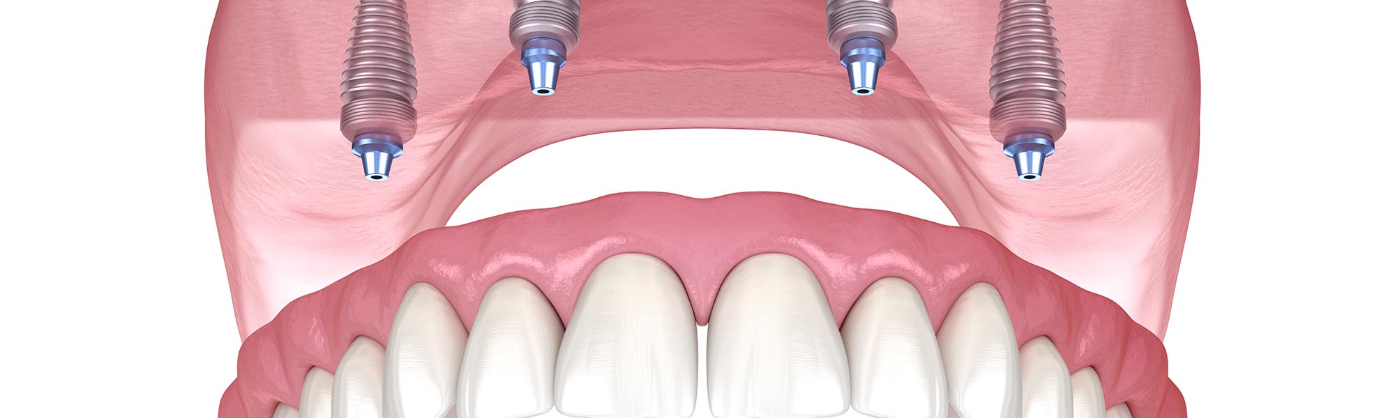 All on 4 Implants Carson CA