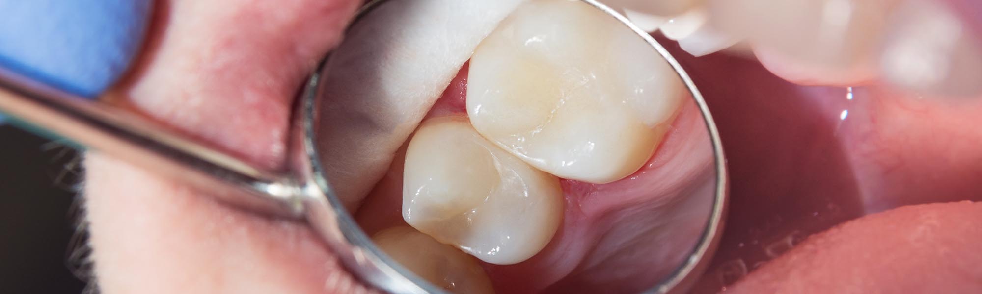 Composite Fillings benefits in Carson CA