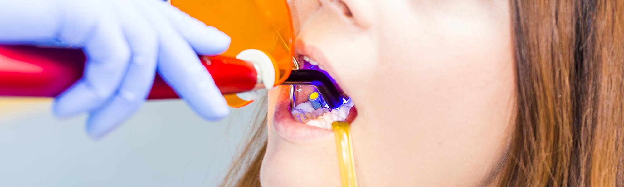 Composite Fillings care in Carson CA