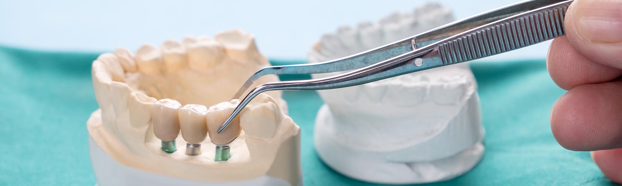 Dental Bridges in Carson CA