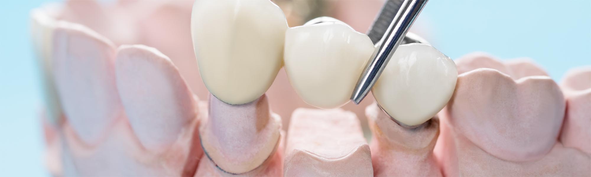 Dental Bridges in Carson CA