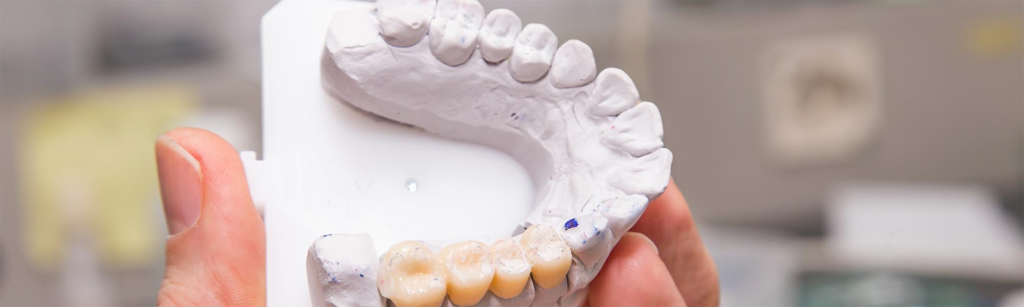 Dental Bridges Type in Carson CA