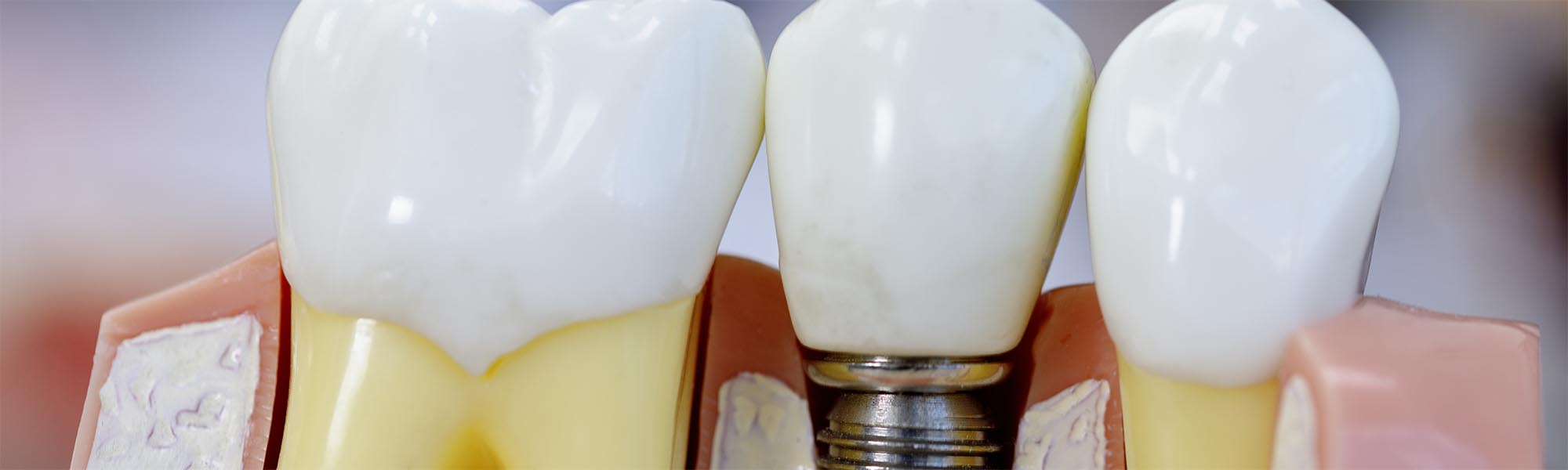 Dental Implants Benefits in Carson CA