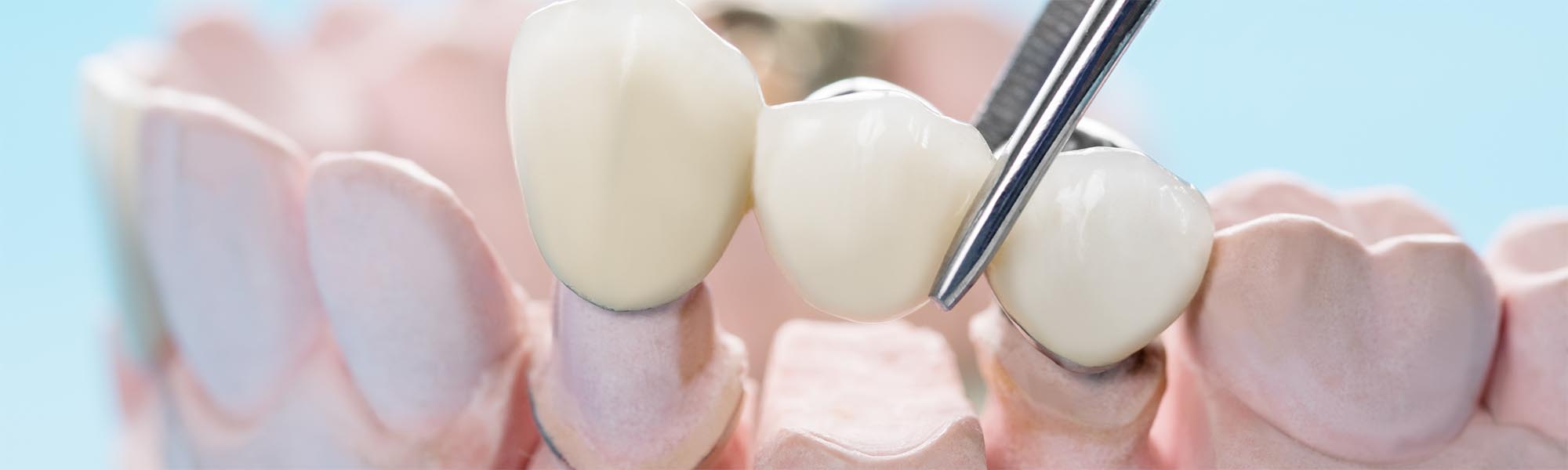 Porcelain Fixed Bridges Carson CA