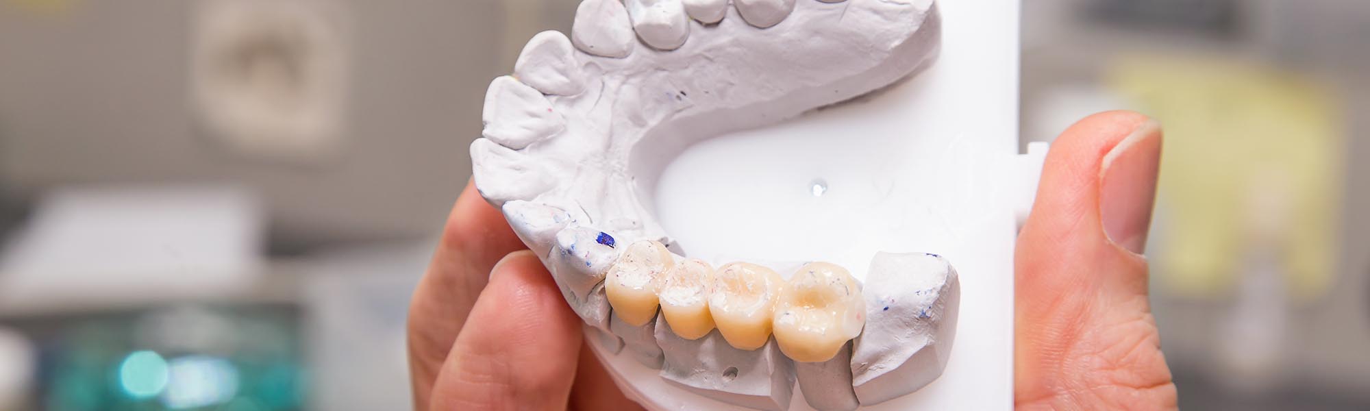 Porcelain Fixed Bridges Carson CA