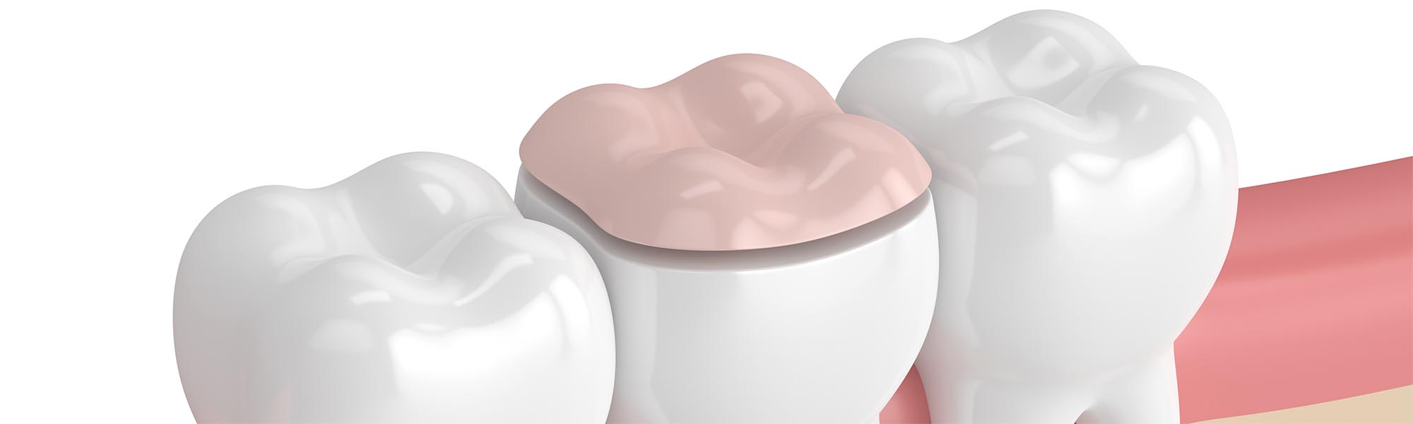 Restorative Inlays & Onlays in Carson CA