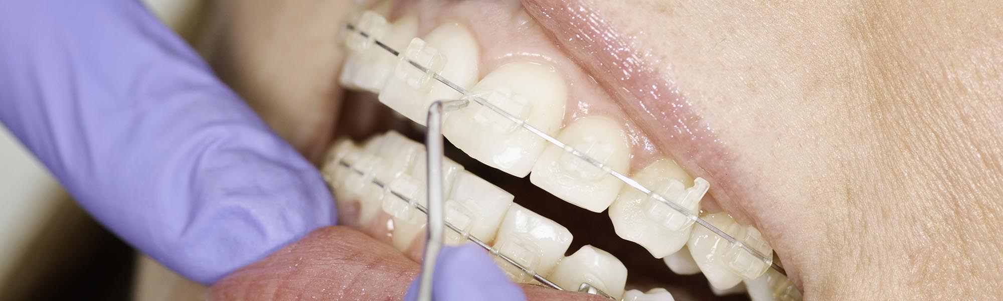 Porcelain Ceramic Braces Carson CA