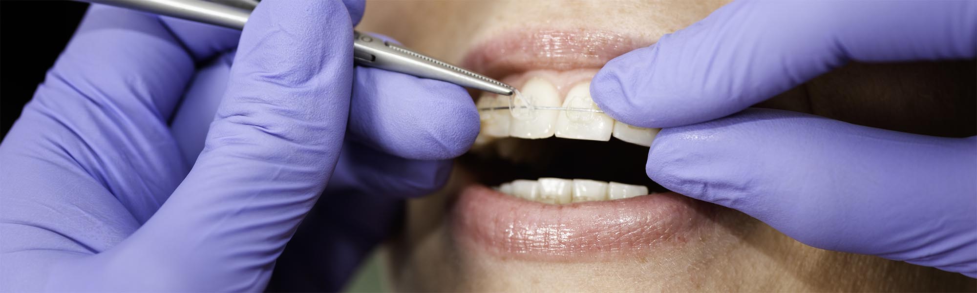 Porcelain Ceramic Braces Carson CA