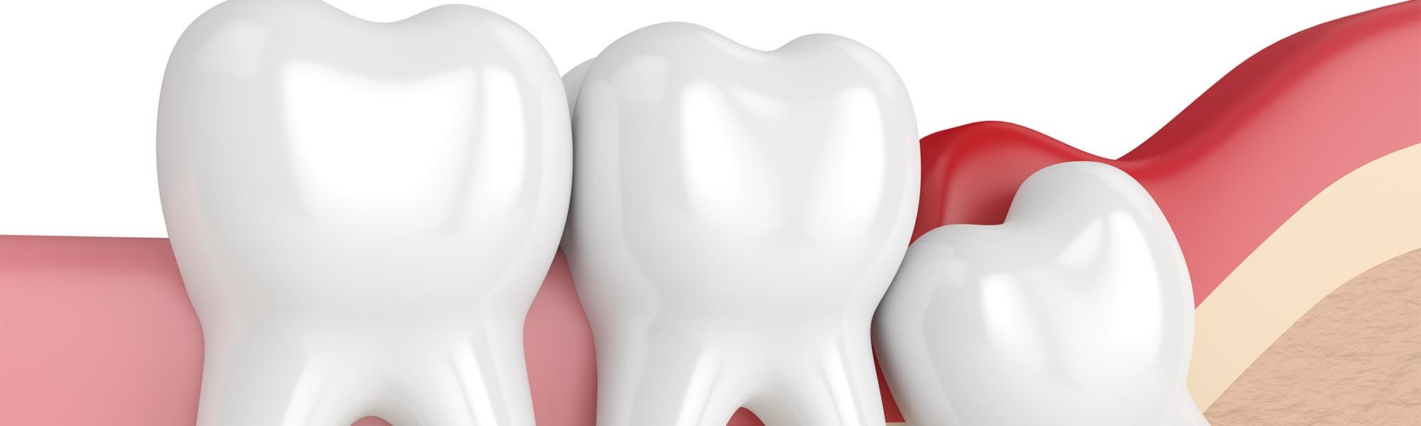 Wisdom Tooth Dentist Carson CA
